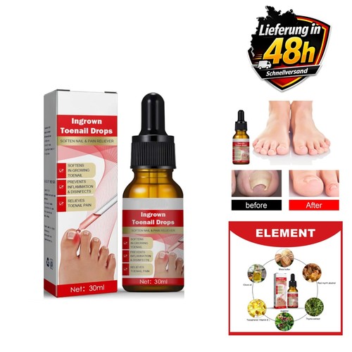 Nagelöl eingewachsene